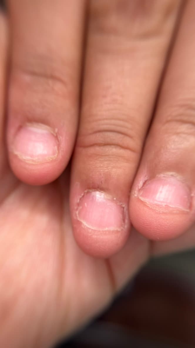 Antes — Uñas comidas hasta la piel
