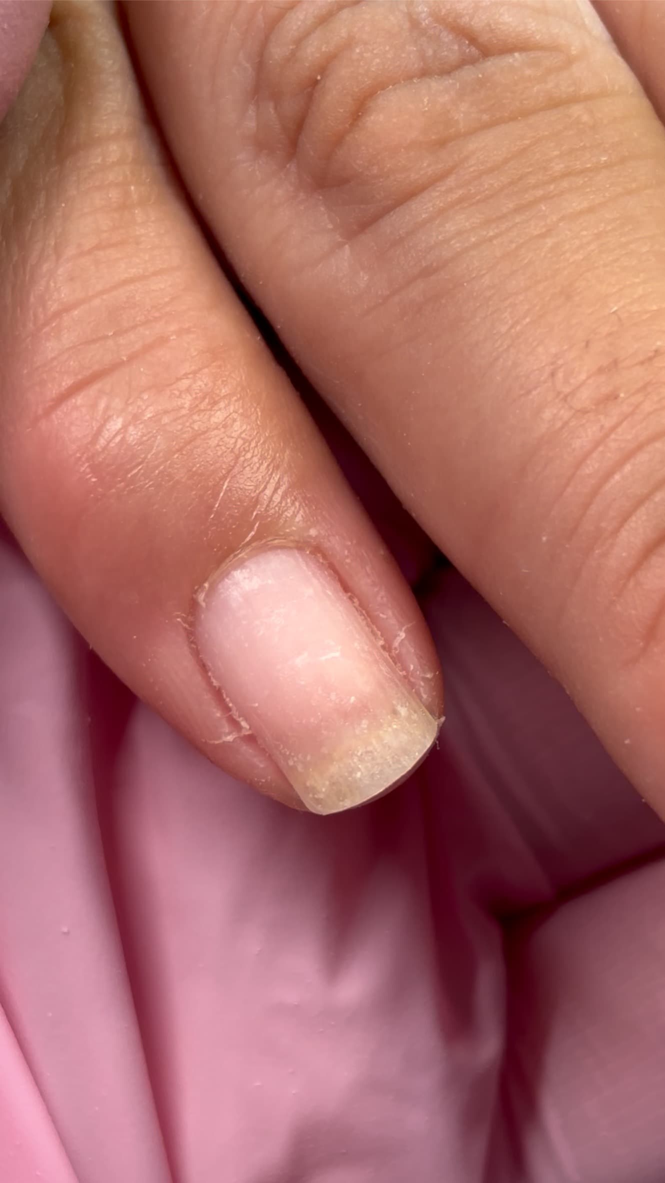 Después — Uñas comidas hasta la piel